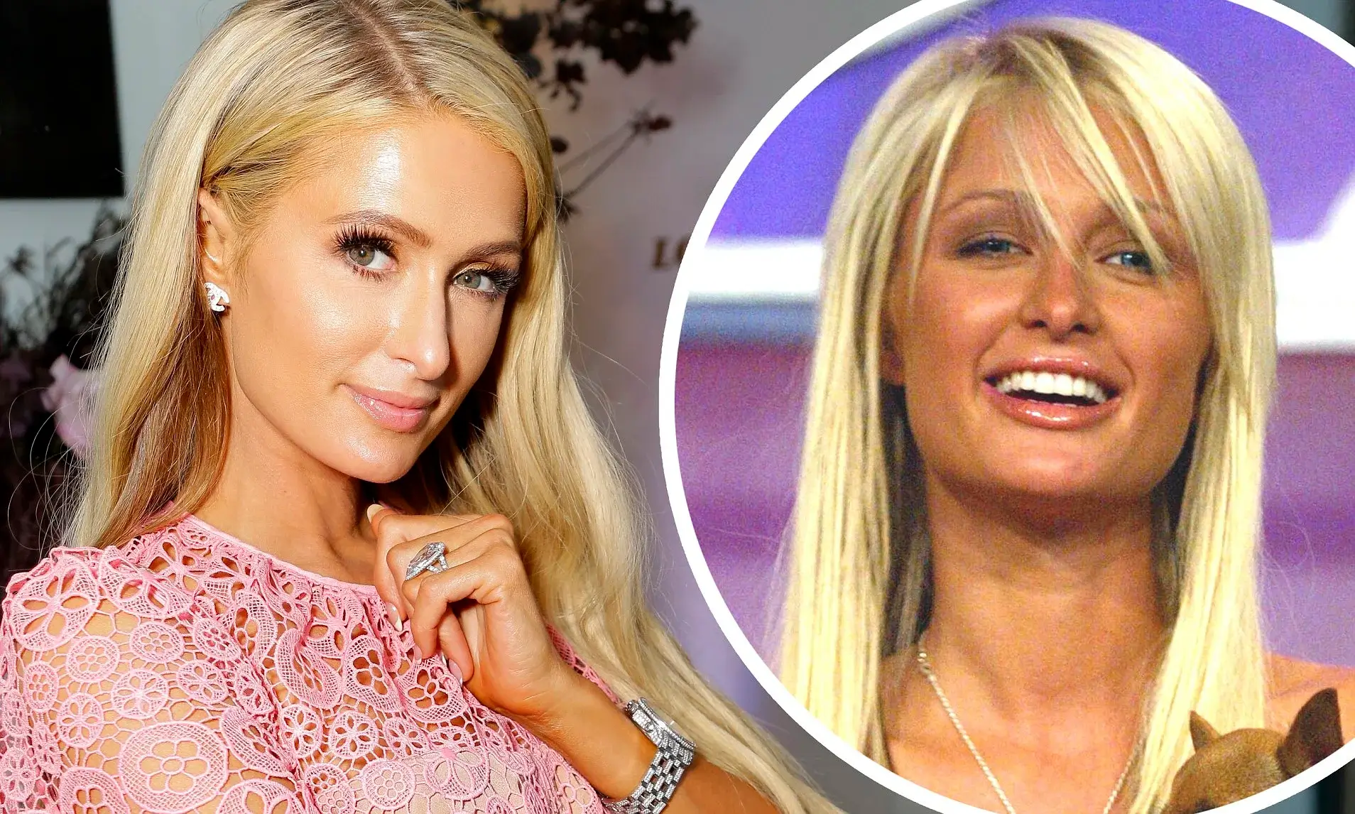 paris hilton plastic surgery before after