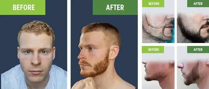 Beard Transplant in Turkey - Clinic Mono