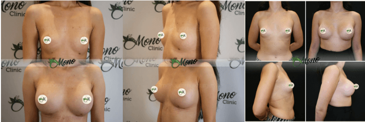 Implantes mamarios en turquía - image 7 - 1