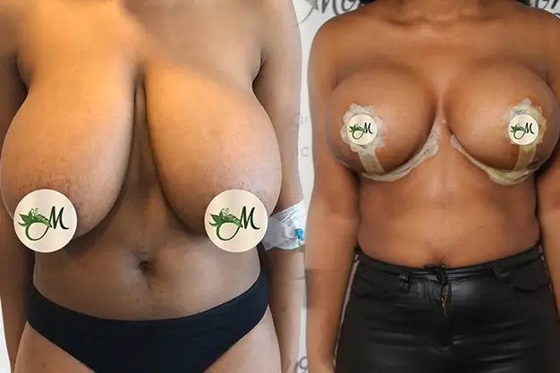 Breast surgeries - breastred 195202214275849 - 2