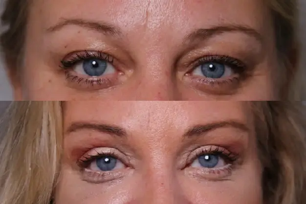 Facial rejuvenation - eyelid - 2