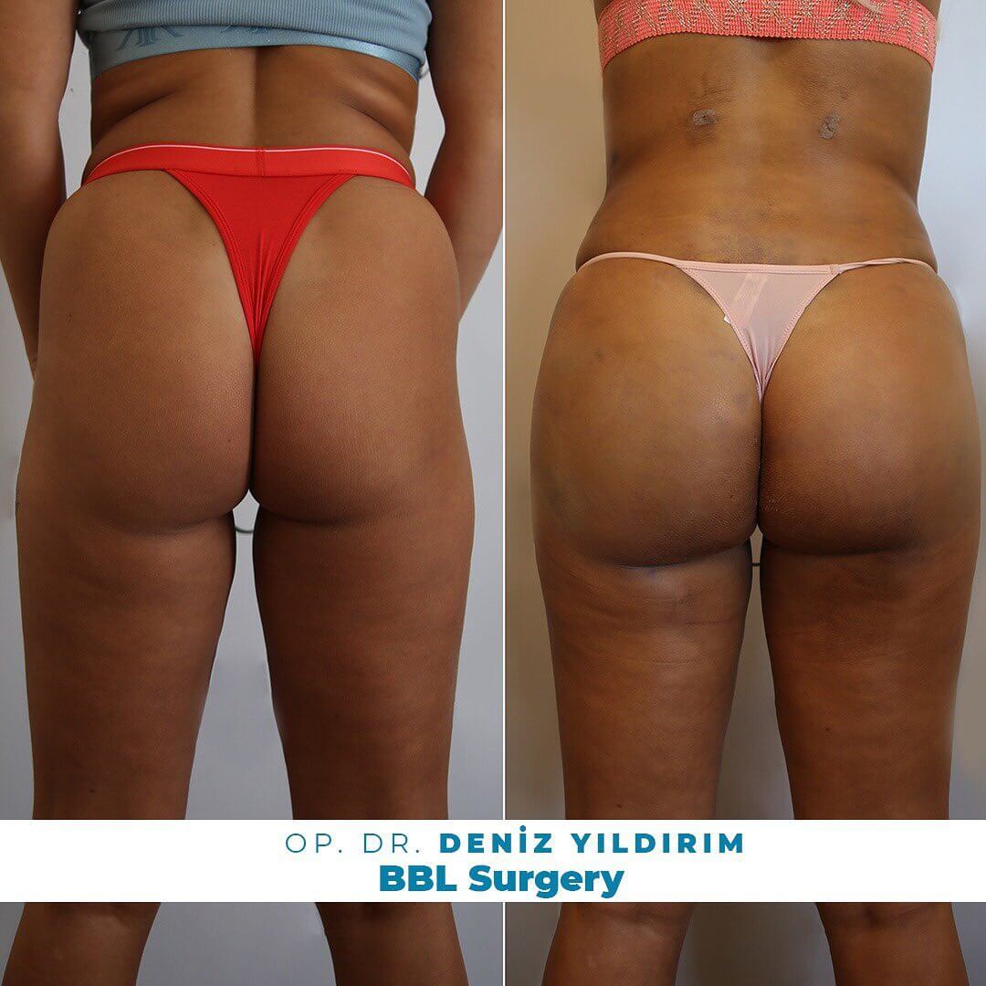Deniz-Yildirim-BBL-Surgery-Before-After