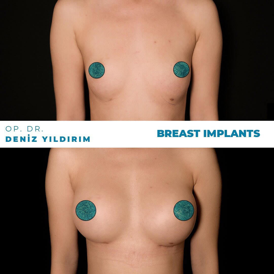 Deniz-Yildirim-Breast-Implants-Before-After-2