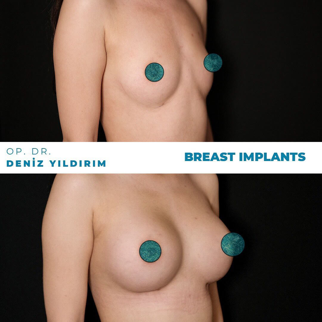 Deniz-yildirim-breast-implants-before-after