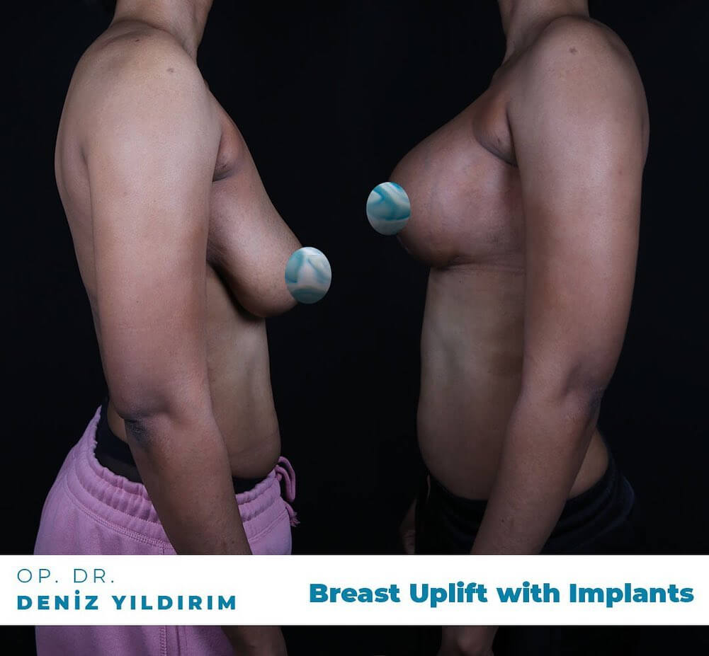 Deniz-yildirim-breast-uplift-with-implants-before-after-2