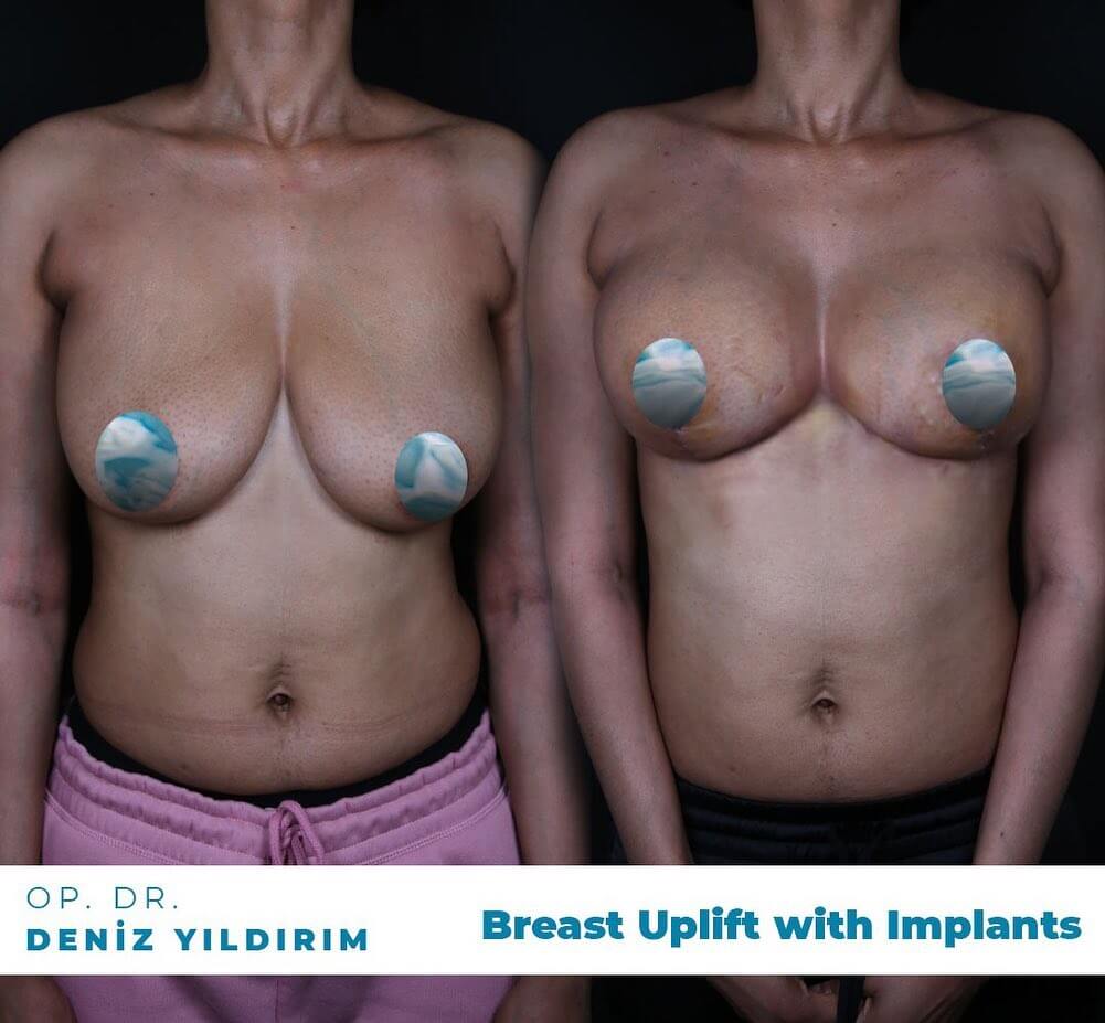 Deniz-yildirim-breast-uplift-with-implants-before-after-3