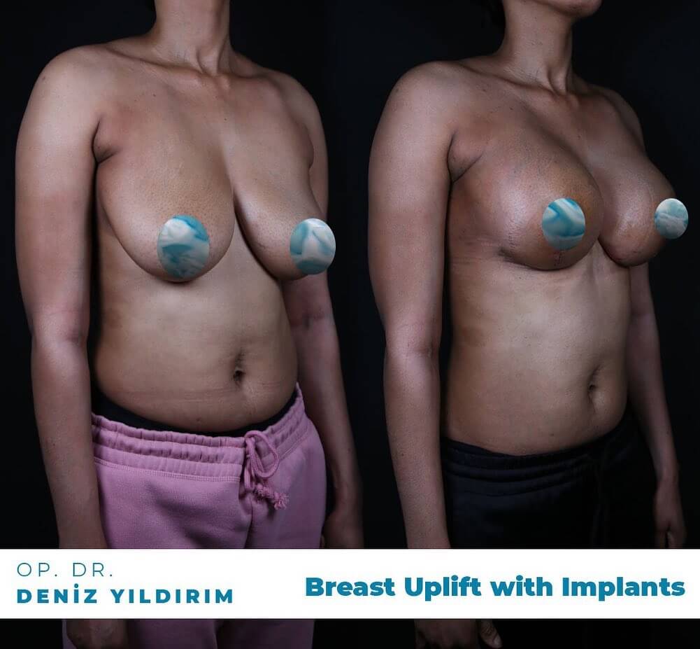 Deniz-yildirim-breast-uplift-with-implants-before-after