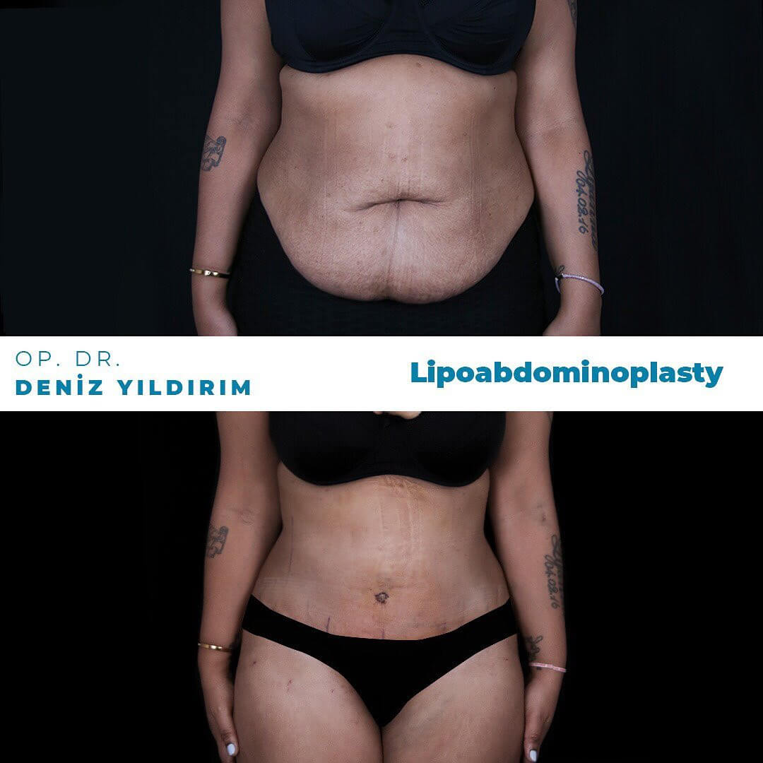 Deniz-yildirim-lipoabdominoplasty-before-after-2-1