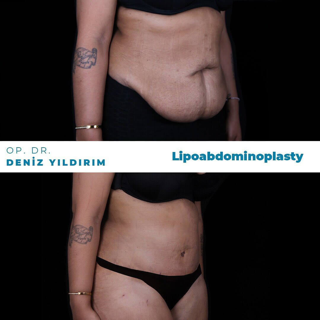 Deniz-yildirim-lipoabdominoplasty-before-after-2-2