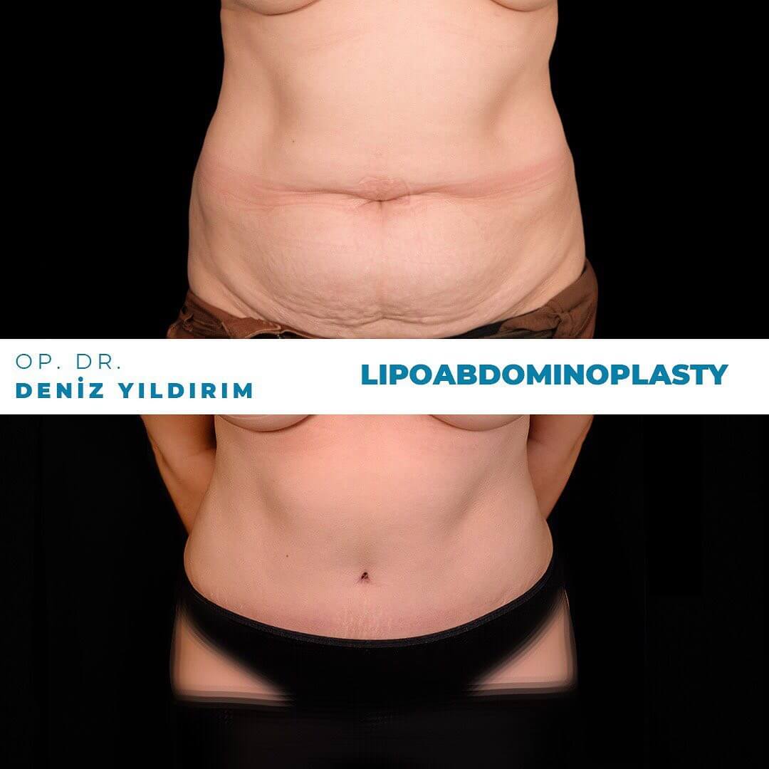 Deniz-yildirim-lipoabdominoplasty-before-after