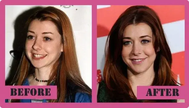 Alyson hannigan plastic surgery before and after