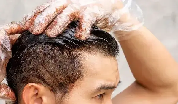 Can-you-dye-your-hair-after-hair-transplant