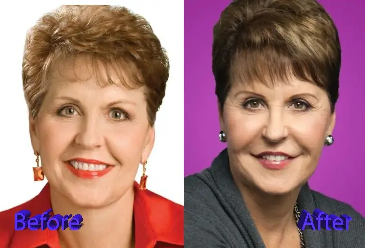 Joyce meyer plastic surgery before and after photos