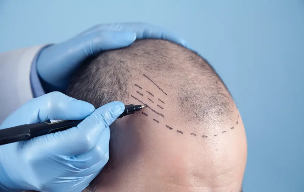 Hair-transplant-recovery