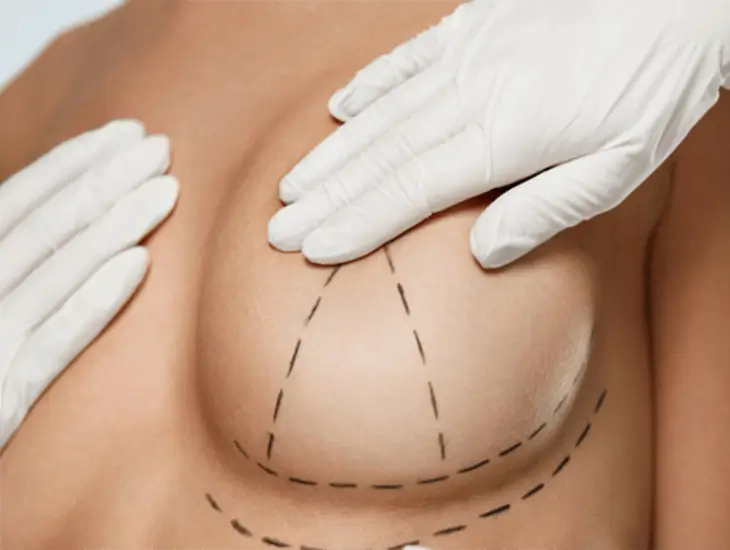 Small Breast Augmentation Surgery - Clinic Mono