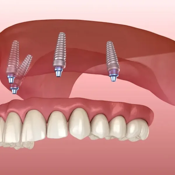 What-is-all-on-4-implant|