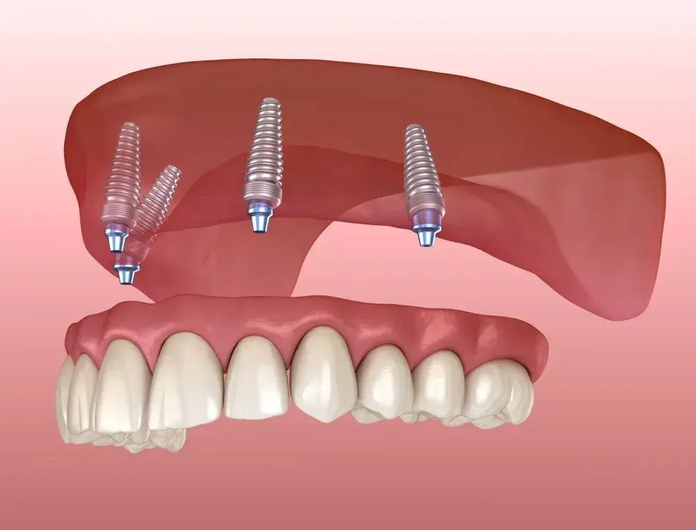 What-is-all-on-4-implant|