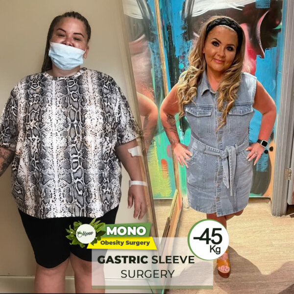 Gastric Sleeve Turkey in Clinic Mono in 2026