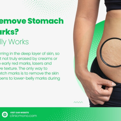 how to get rid of stretch marks, can stretch marks be removed, stretch mark removal, striae, red vs white stretch marks