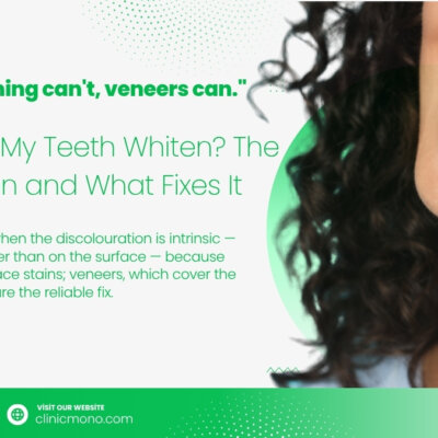 Teeth won't whiten when the discolouration is intrinsic — inside the tooth rather than on the surface — because bleach only lifts surface stains; veneers, which cover the teeth in any shade, are the reliable fix.