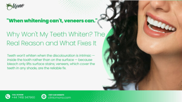 Teeth won't whiten when the discolouration is intrinsic — inside the tooth rather than on the surface — because bleach only lifts surface stains; veneers, which cover the teeth in any shade, are the reliable fix.