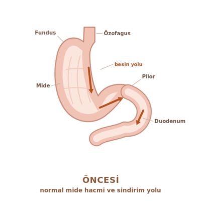 Gastrik bypass öncesi: normal mide hacmi ve besinin mideden onikiparmak bağırsağına geçtiği sindirim yolu