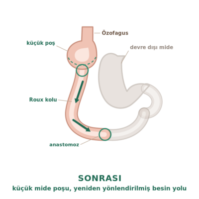 Gastrik bypass sonrası: 20-30 ml küçük mide poşu, Roux kolu ve devre dışı bırakılan mide bölümü
