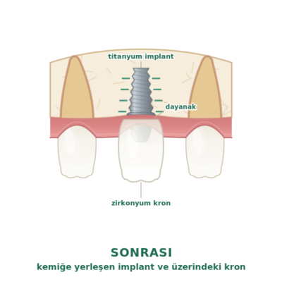 Diş implantı sonrası: kemikle kaynaşmış implant üzerine takılmış kron
