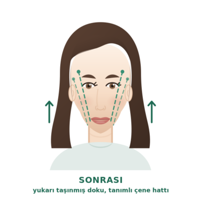 İp askı sonrası: yukarı taşınmış doku ve daha belirgin çene hattı