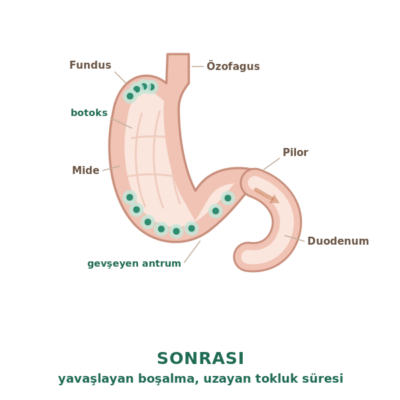 Mide botoksu sonrası: enjeksiyon noktaları ile yavaşlamış mide boşalması ve uzayan tokluk hissi
