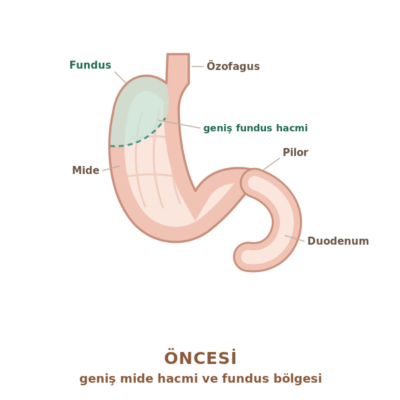 Tüp mide ameliyatı öncesi: fundus dâhil tam hacimli normal mide anatomisi